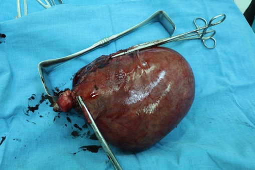 Bóc tách khối u xơ tử cung nặng 3kg