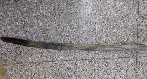 (Hy hữu) Bị cọc gỗ đâm xuyên tầng sinh môn 30cm 