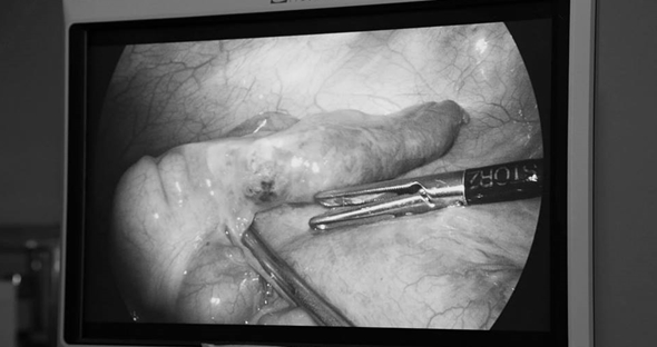 Mổ ruột thừa phát hiện xương cá đâm thủng thành ruột